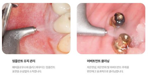 천안 임플란트 치료 기간
