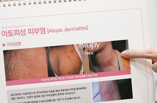 생기한의원이 안내하는 아토피 스트레스 영향 관련 정보