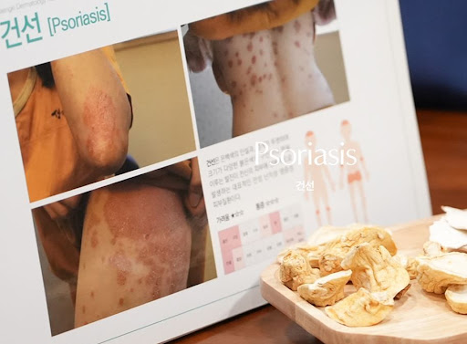 생기한의원 건선 관련, 계절에 따른 피부 상태 변화 안내